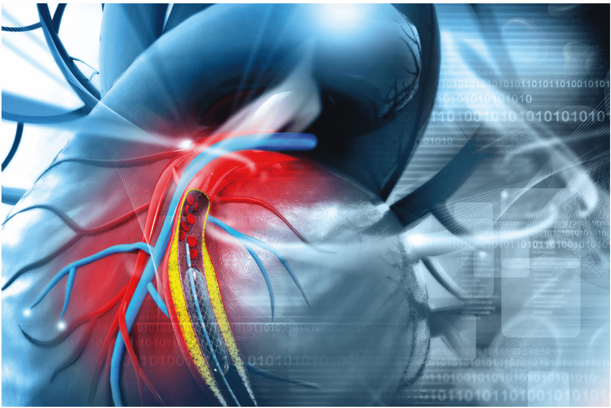 Actualités De La Cardiologie Interventionnelle Cardiologie Pratique