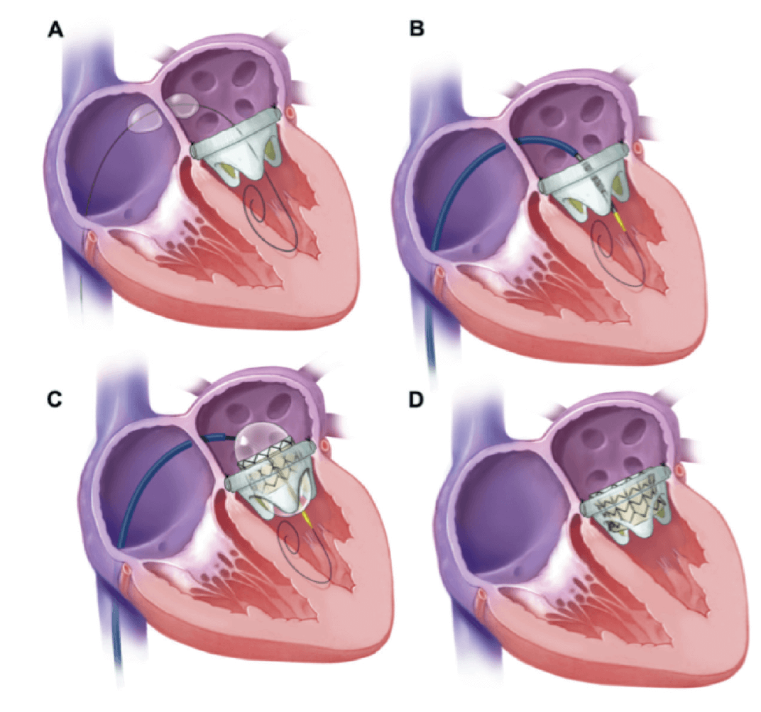 Remplacement de valves pulmonaires et endocardites infectieuses : quel  risque avec la valve SAPIEN ? - MediQuality