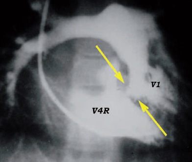 sténose aortique radiographie