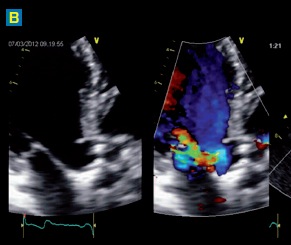 sténose aortique radiographie