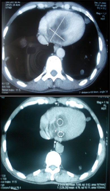 emplacement du septum interventriculaire