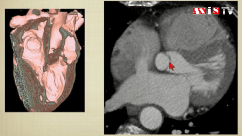Valve aortique - C.I.I.C - Centre Interventionnelle et Imagerie Médicale